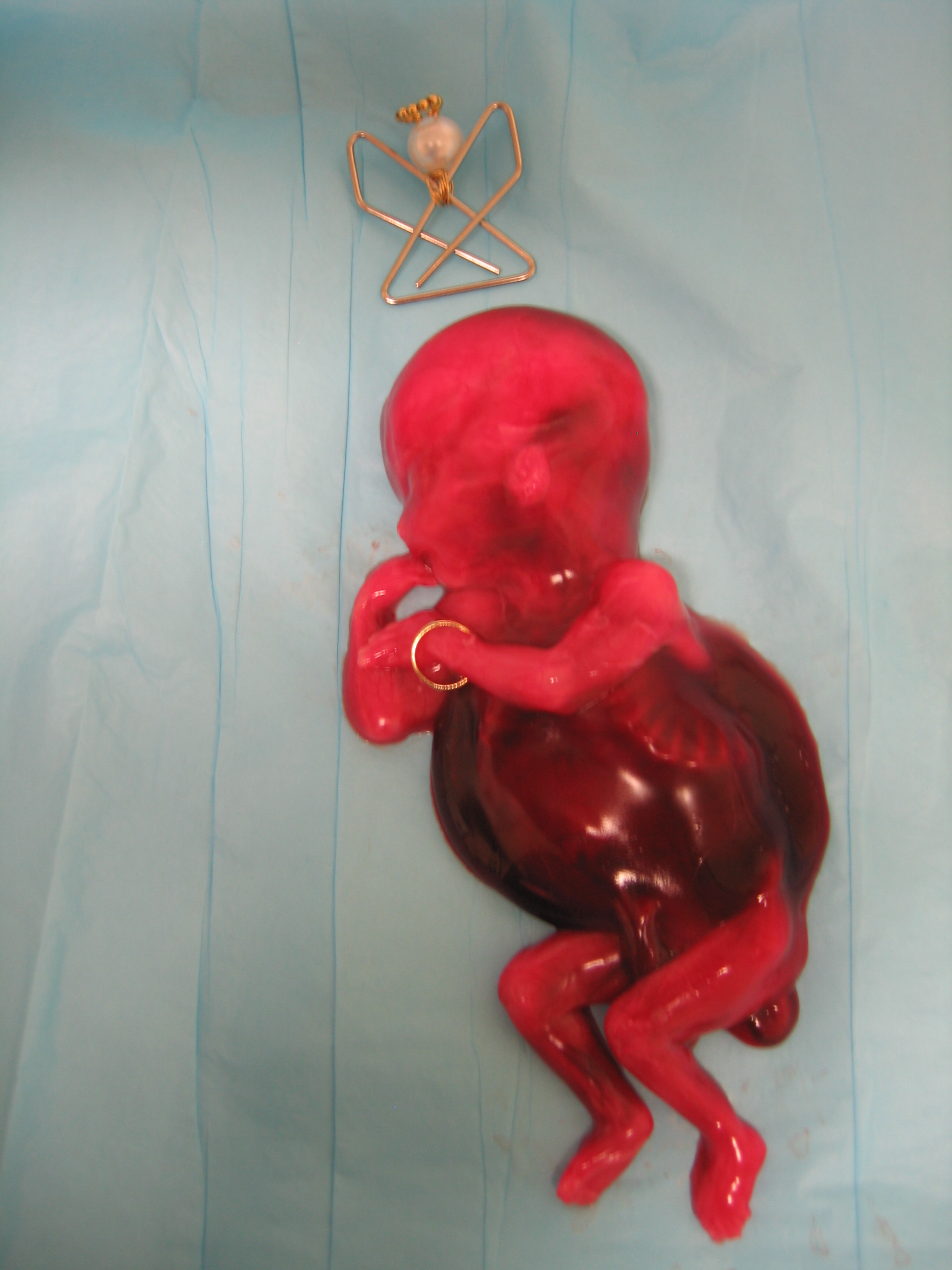 20 week fetus born