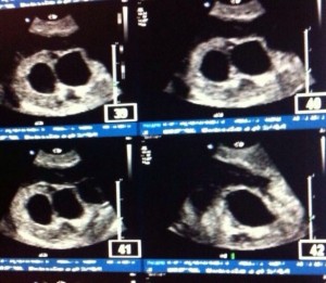 Triplet Blighted Ovum